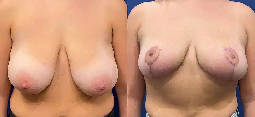 Breast Reduction Before & After