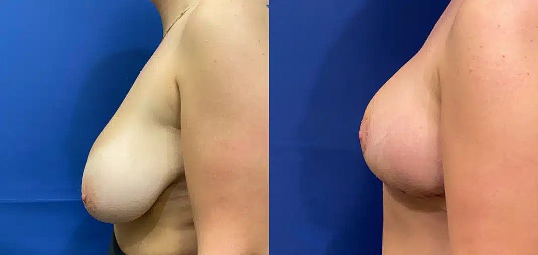Breast Reduction Before & After