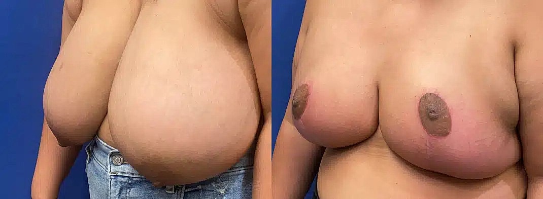 Breast Reduction Before & After