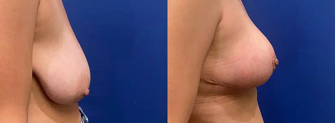 Reduccion De Senos Before & After