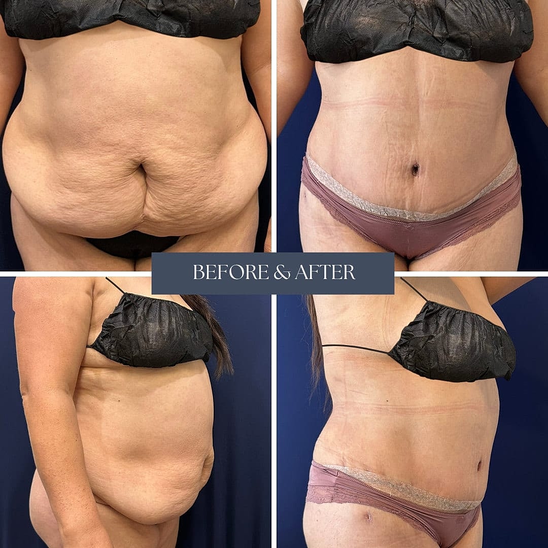 Abdominoplastia Before & After