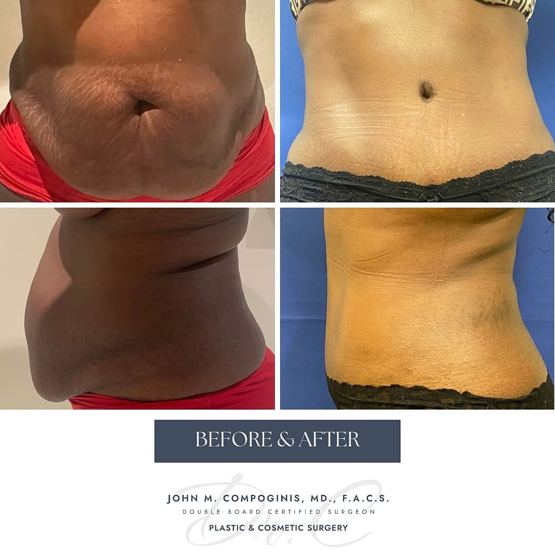 Abdominoplastia Before & After