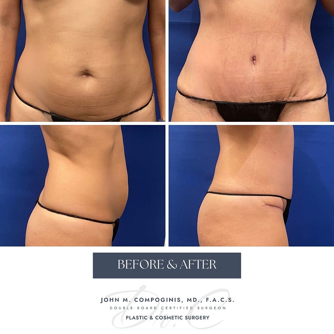 Abdominoplastia Before & After