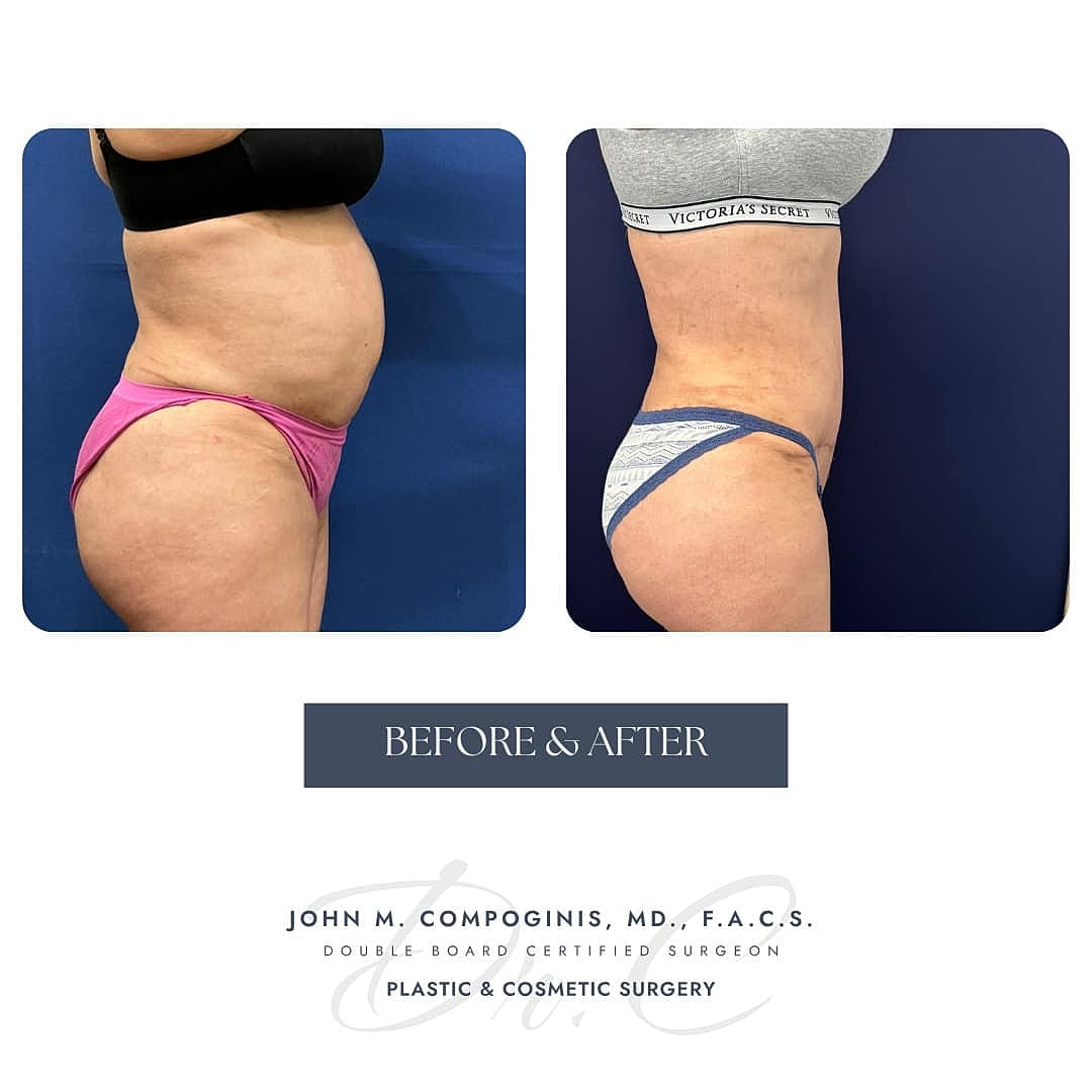 Abdominoplastia Before & After