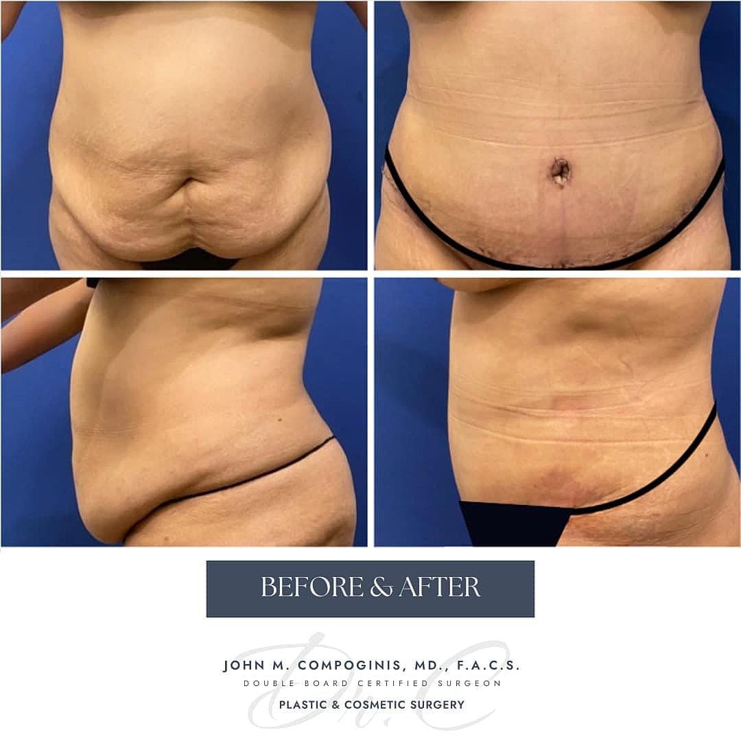 Abdominoplastia Before & After