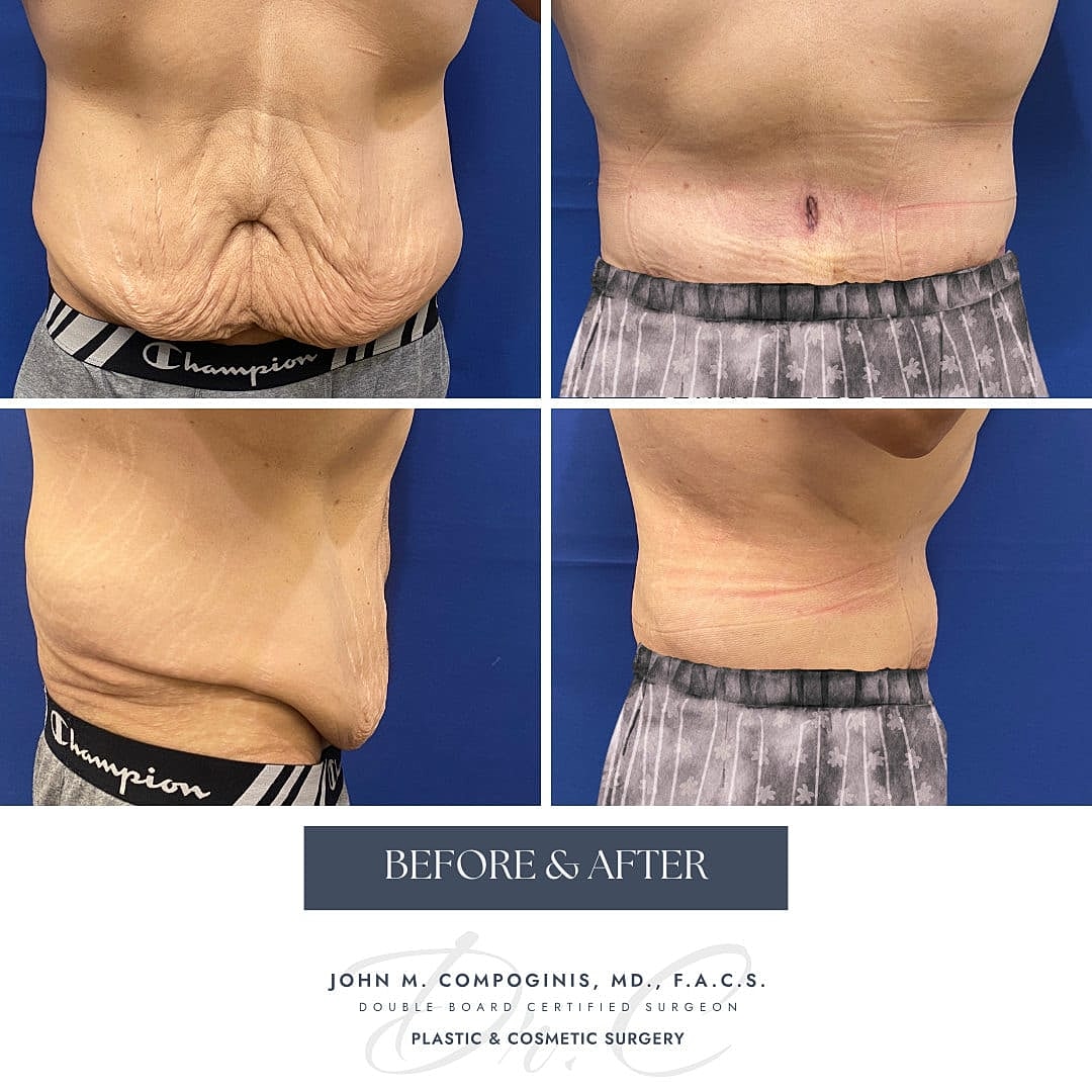 Abdominoplastia Before & After