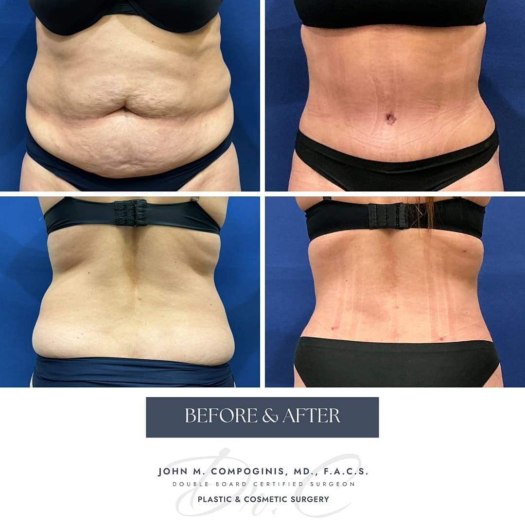 Abdominoplastia Before & After