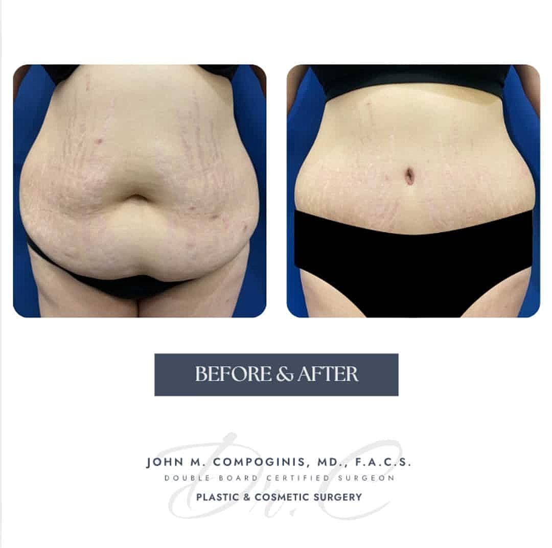 Abdominoplastia Before & After