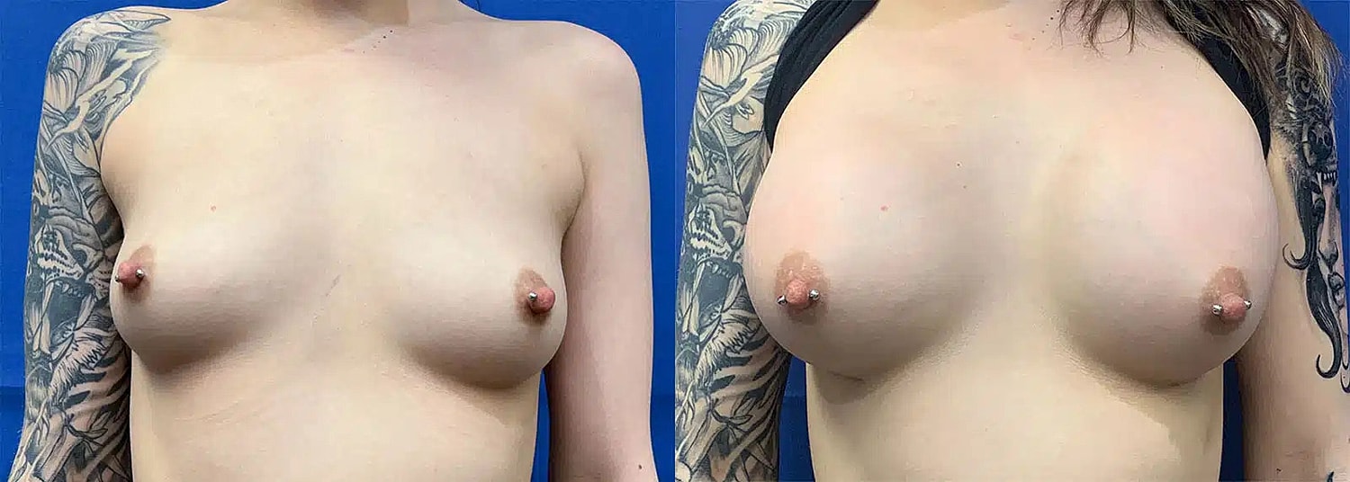 Breast Augmentation Before & After