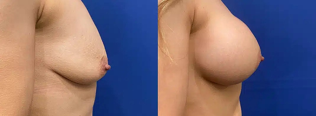 Breast Augmentation Before & After