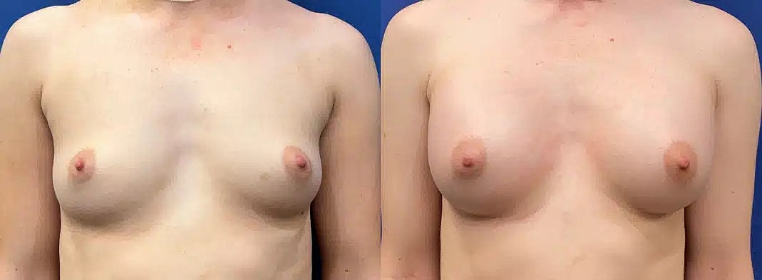 Breast Augmentation Before & After