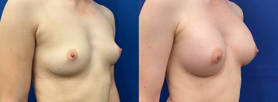 Breast Augmentation Before & After