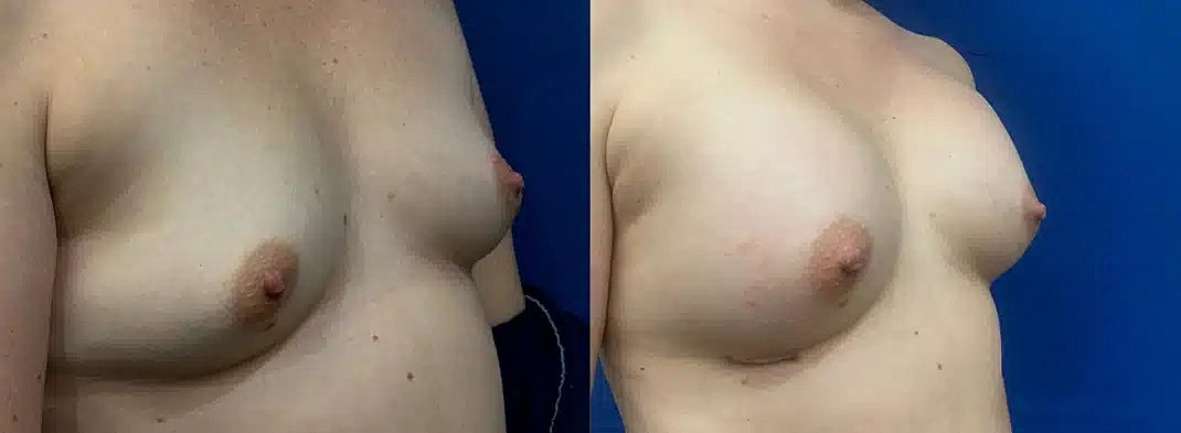 Breast Augmentation Before & After