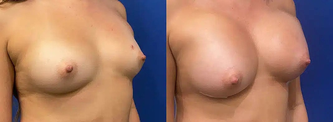 Breast Augmentation Before & After