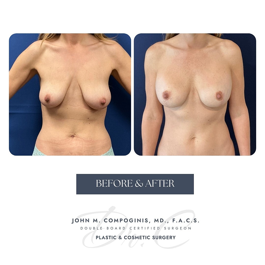 Breast augmentation before and after comparison.