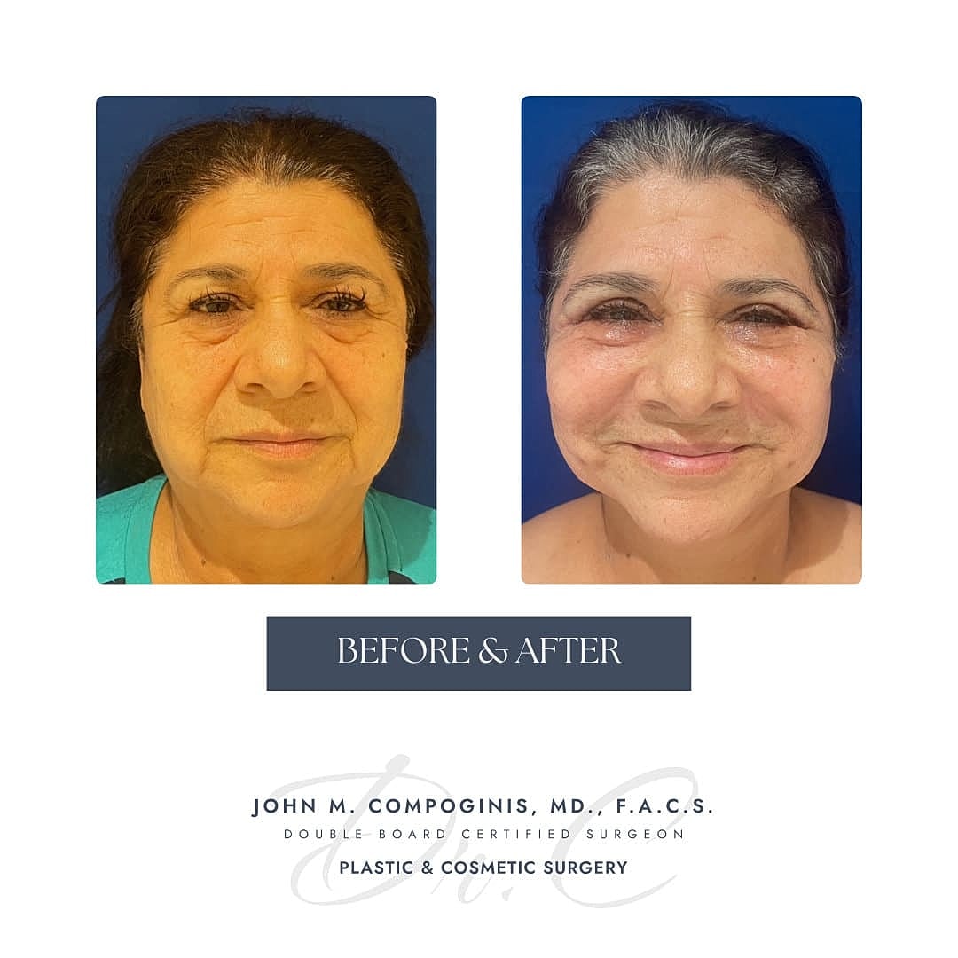 Facelift Before & After