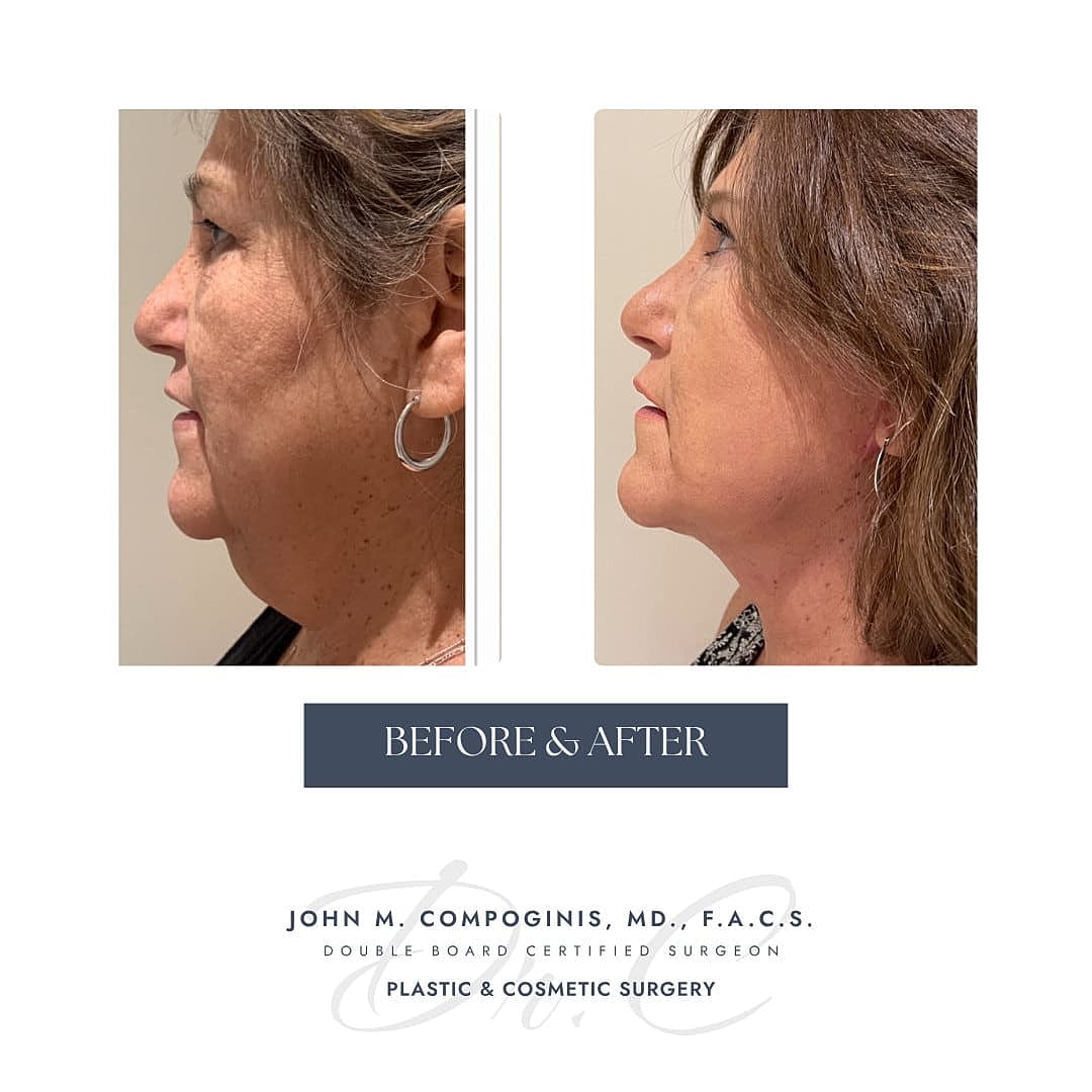 Facelift Before & After