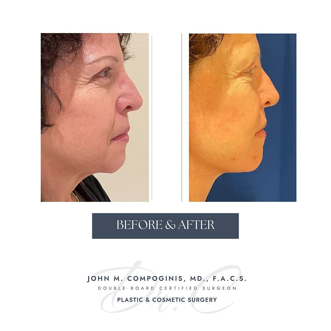 Facelift Before & After