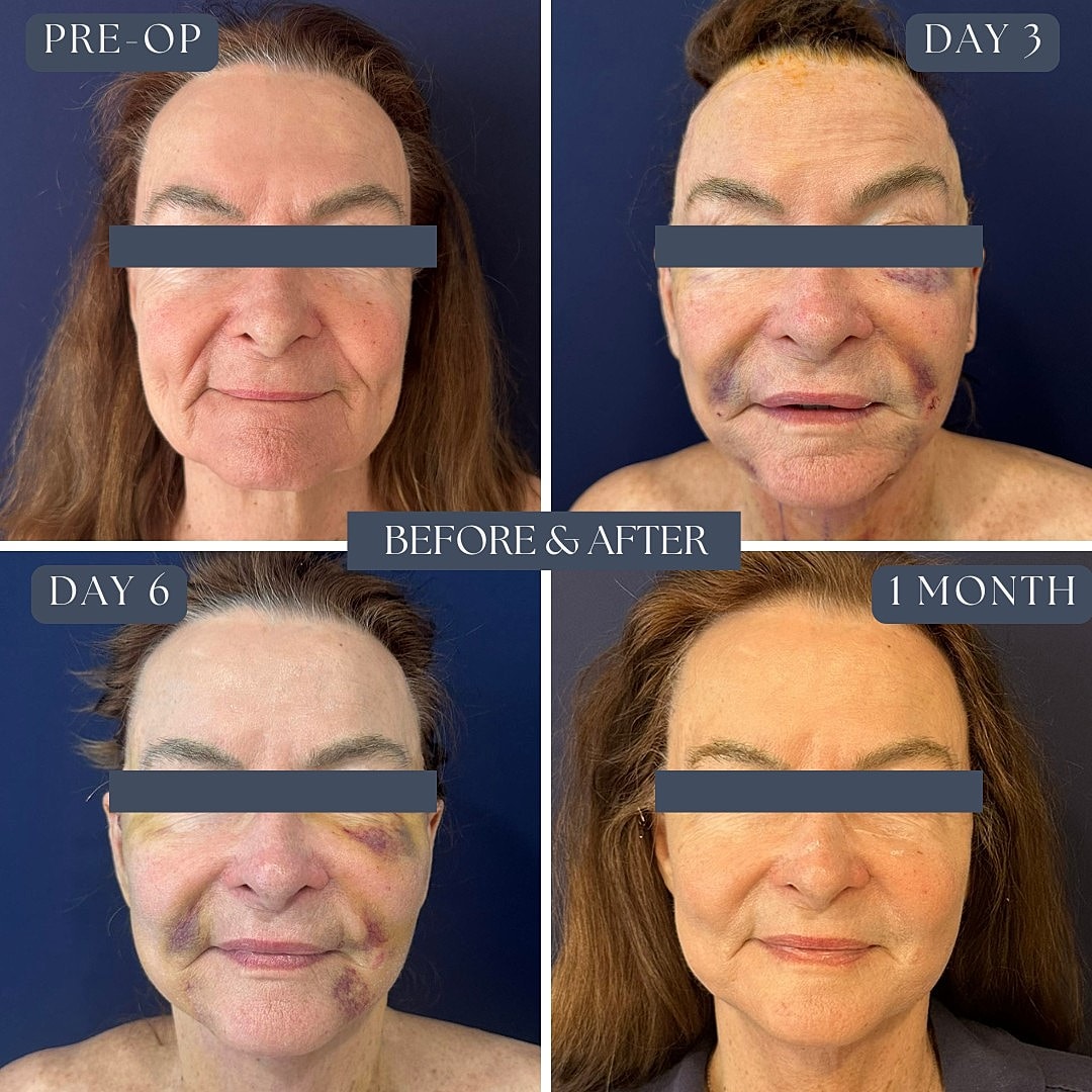 Facial transformation: before and after procedure.
