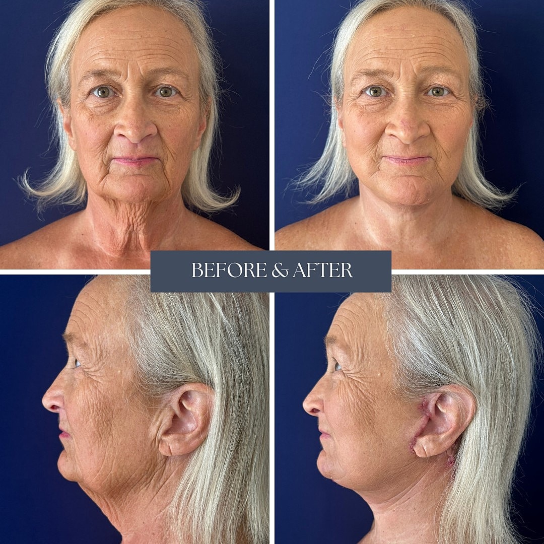 Before and after facial rejuvenation treatment images.