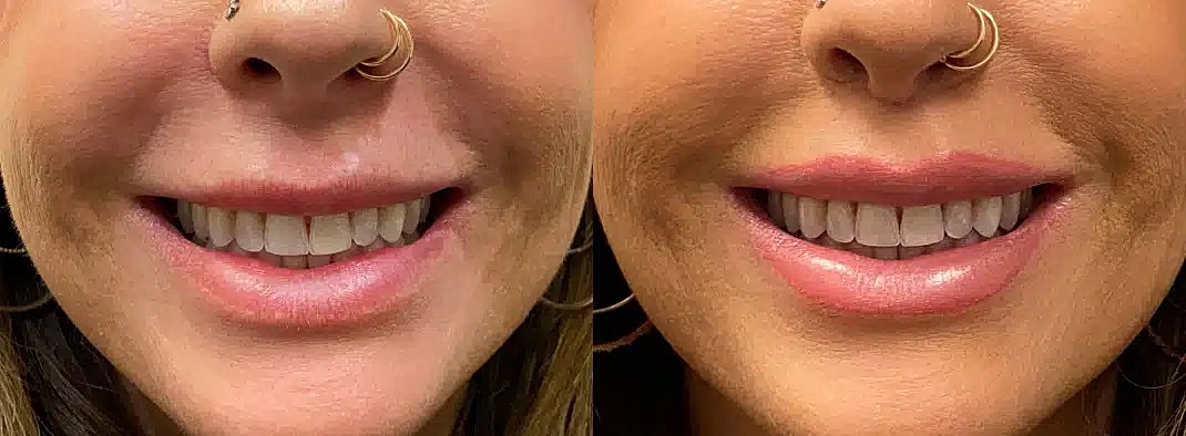Lip Enhancement Before & After
