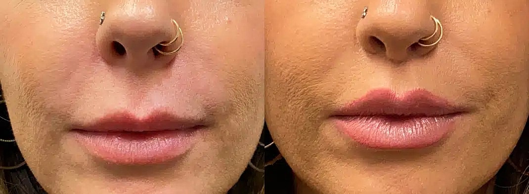 Lip Enhancement Before & After