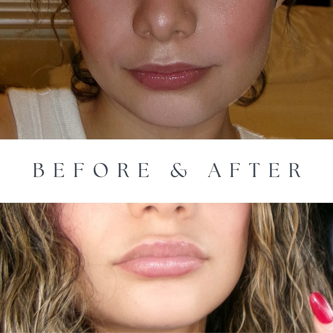 Lip enhancement before and after transformation.
