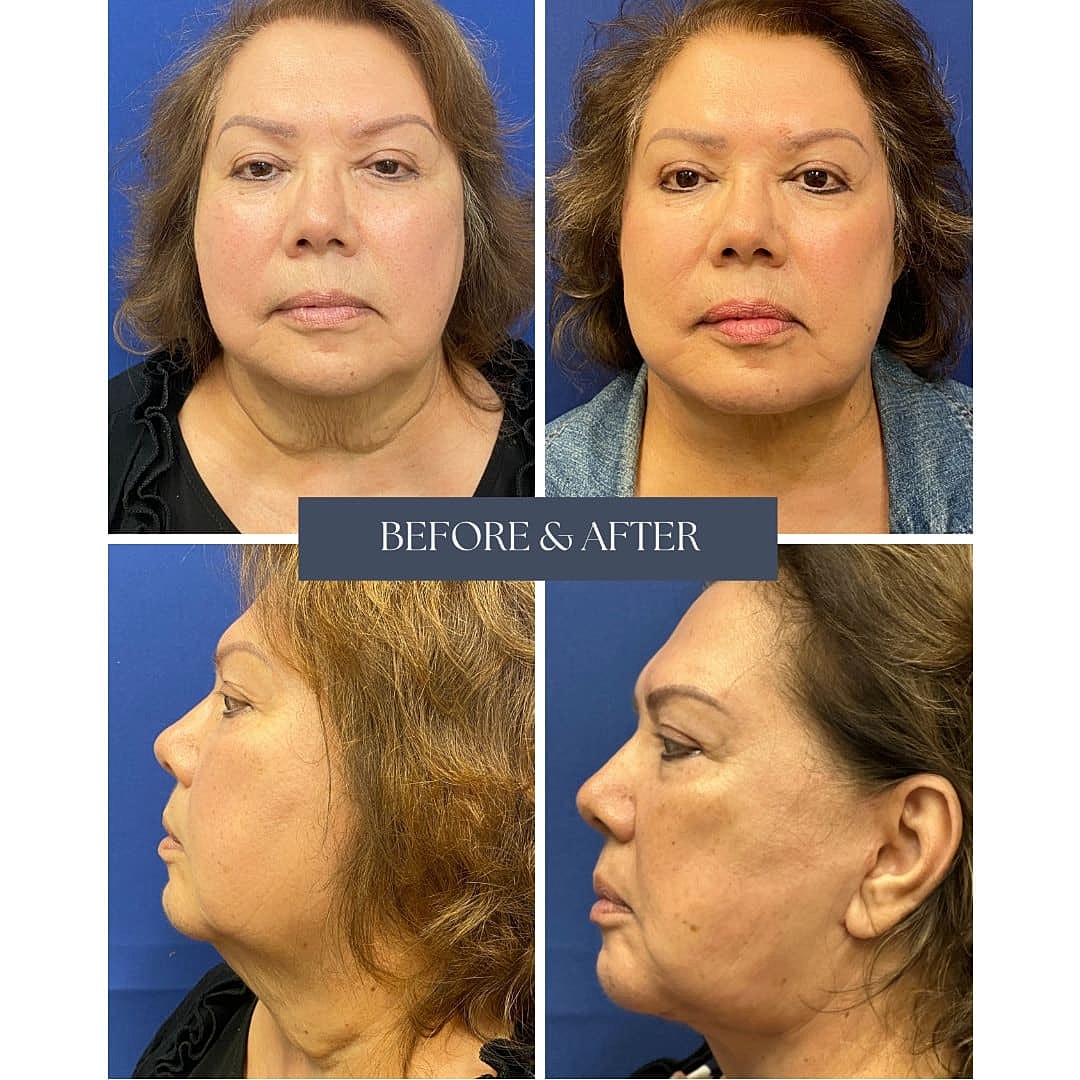 Rejuvenecimiento Facial Before & After