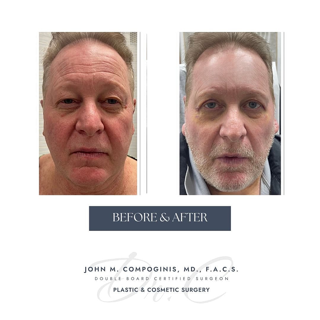 Rejuvenecimiento Facial Before & After