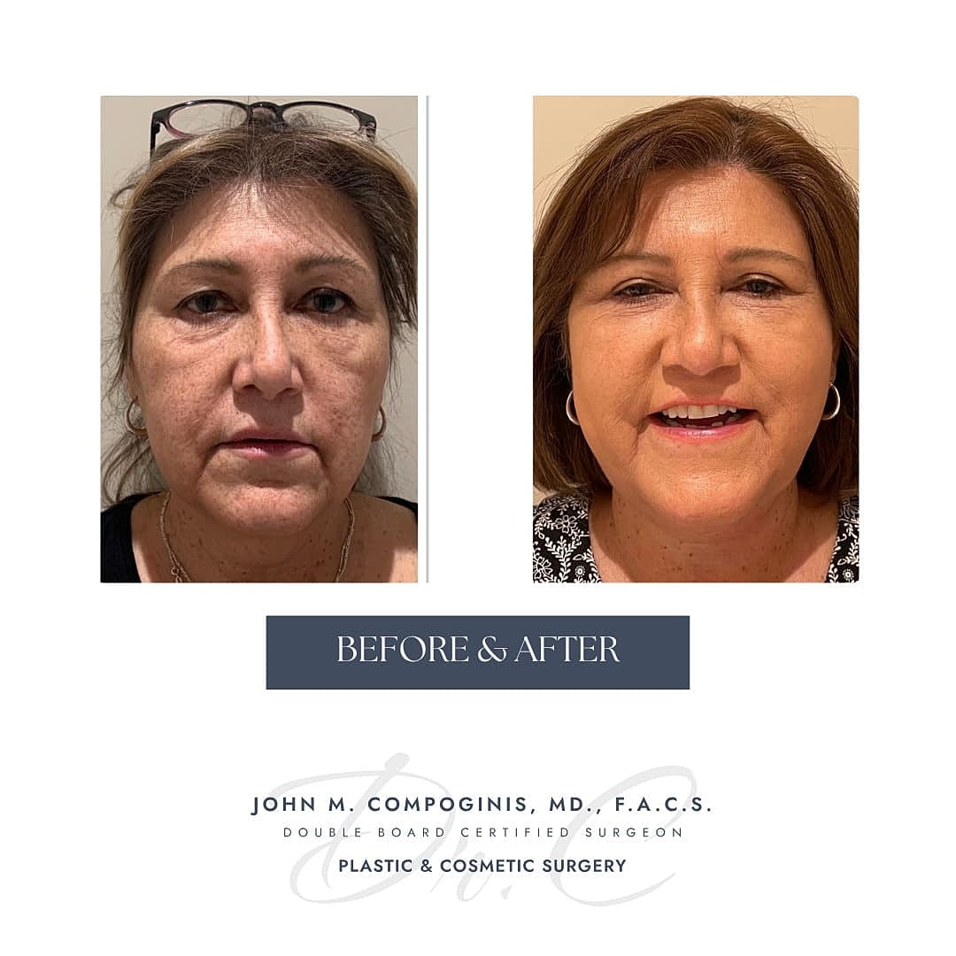 Rejuvenecimiento Facial Before & After