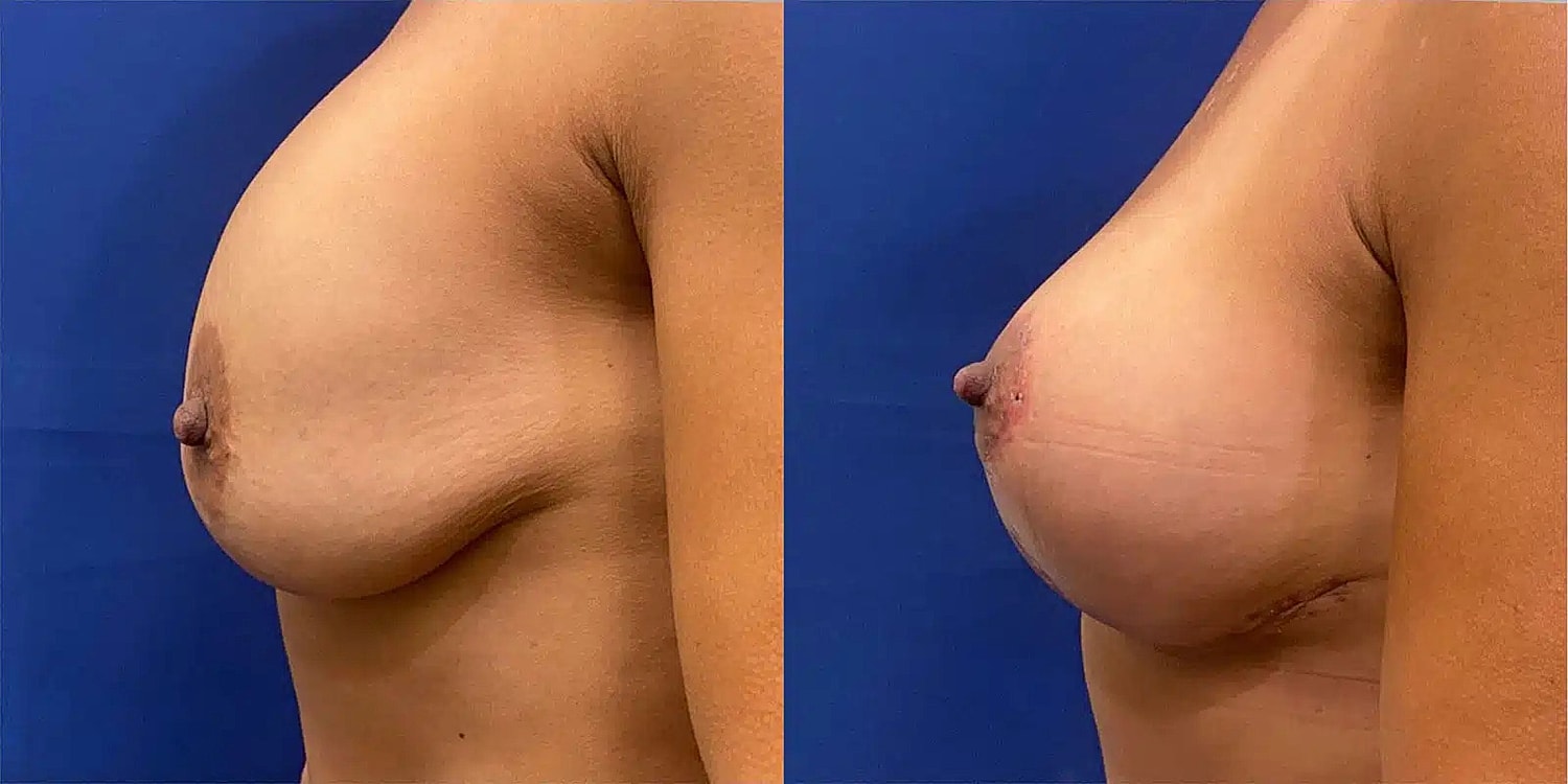 Breast Lift Before & After