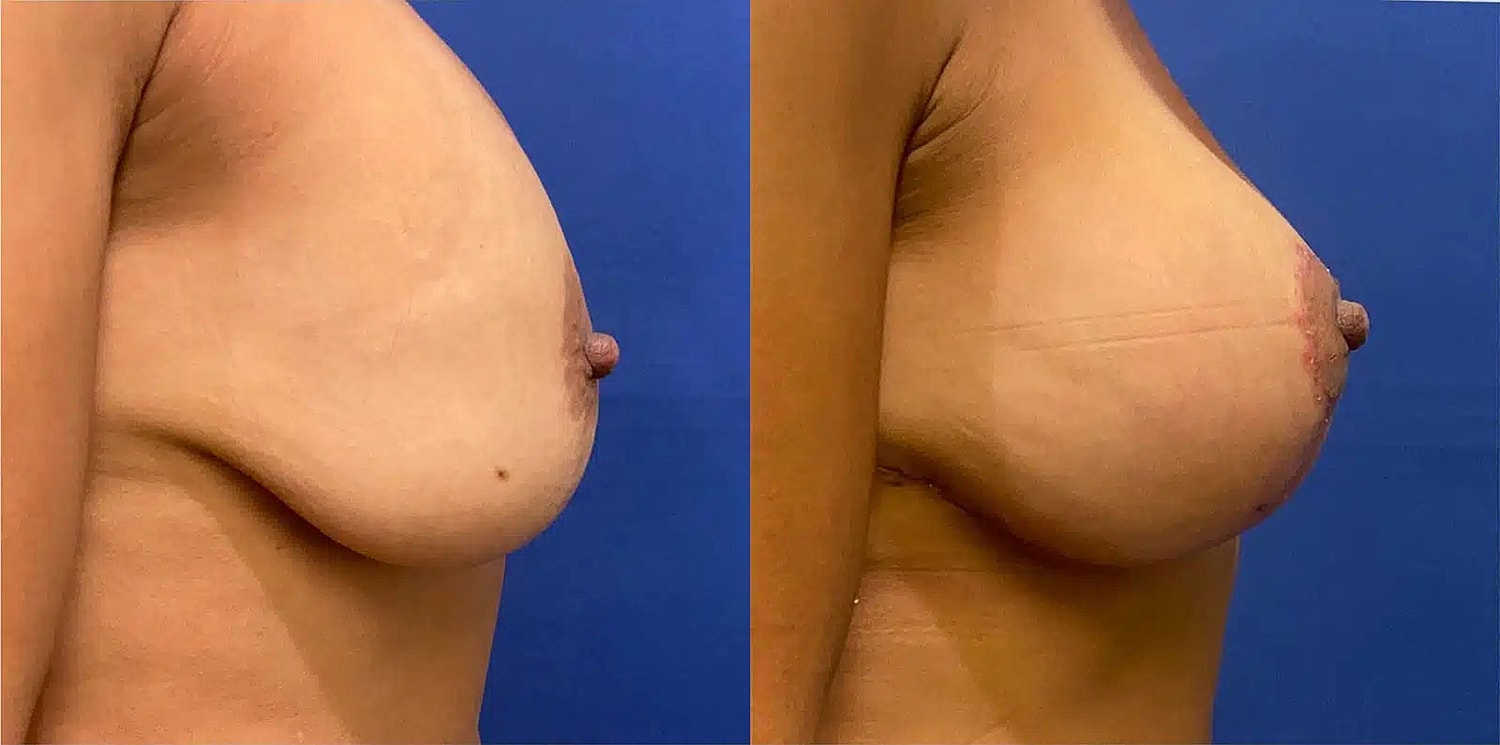 Breast Lift Before & After