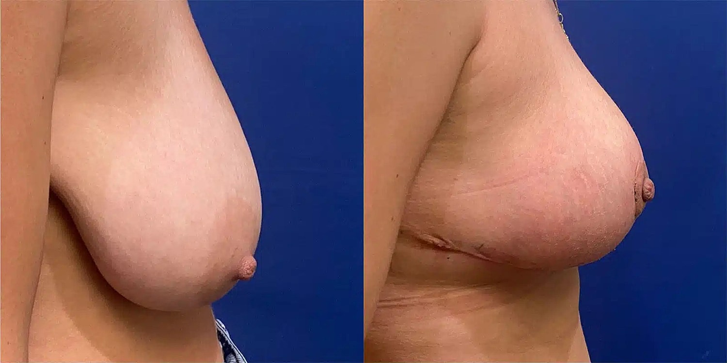 Breast Lift Before & After