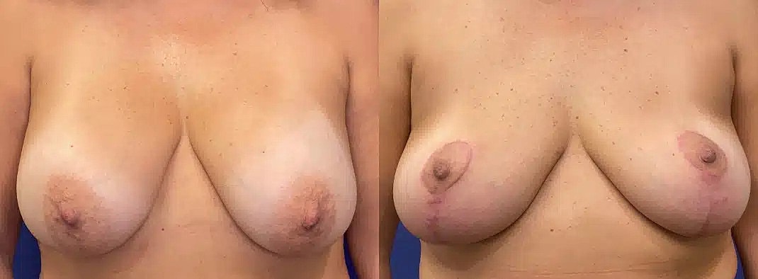 Breast Lift Before & After