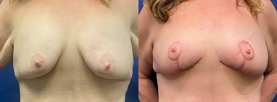 Breast Lift Before & After