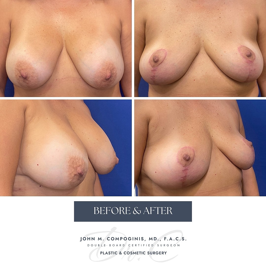 Before and after breast surgery comparison images