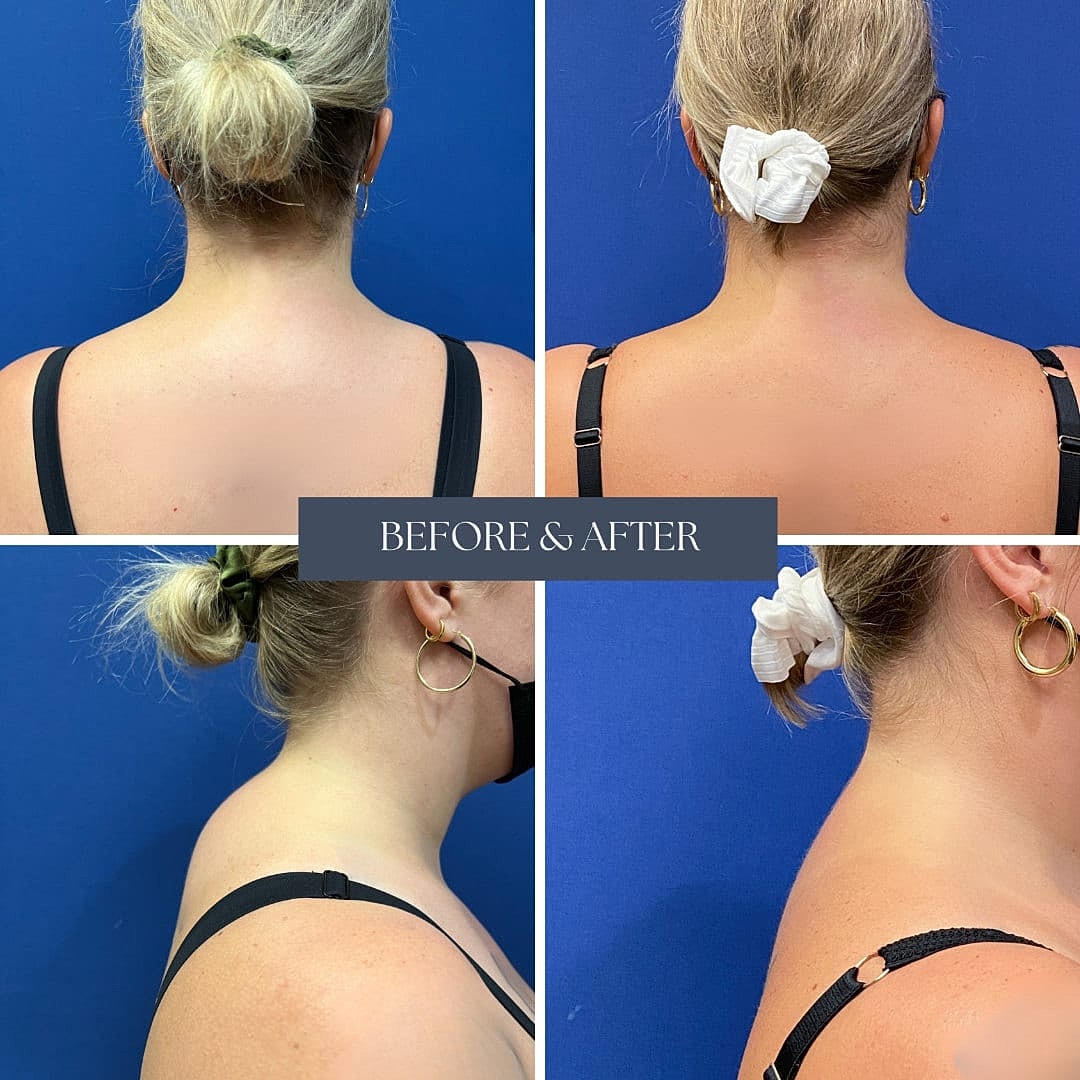 Liposuccion Before & After
