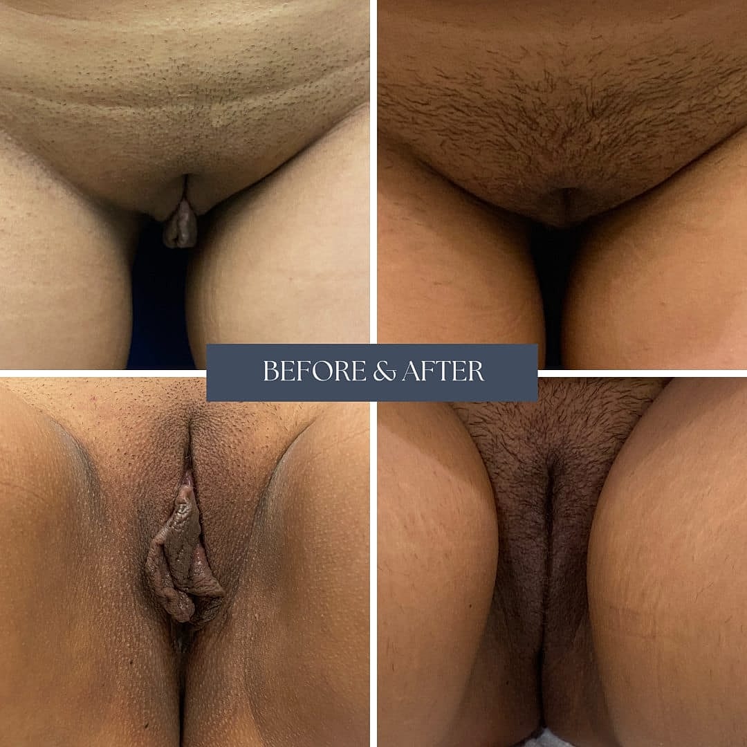 Labioplastia Before & After