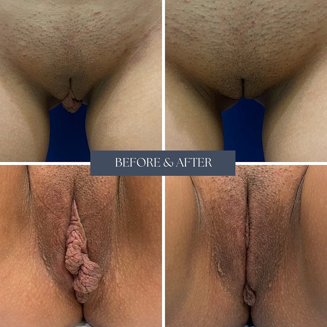 Labioplastia Before & After