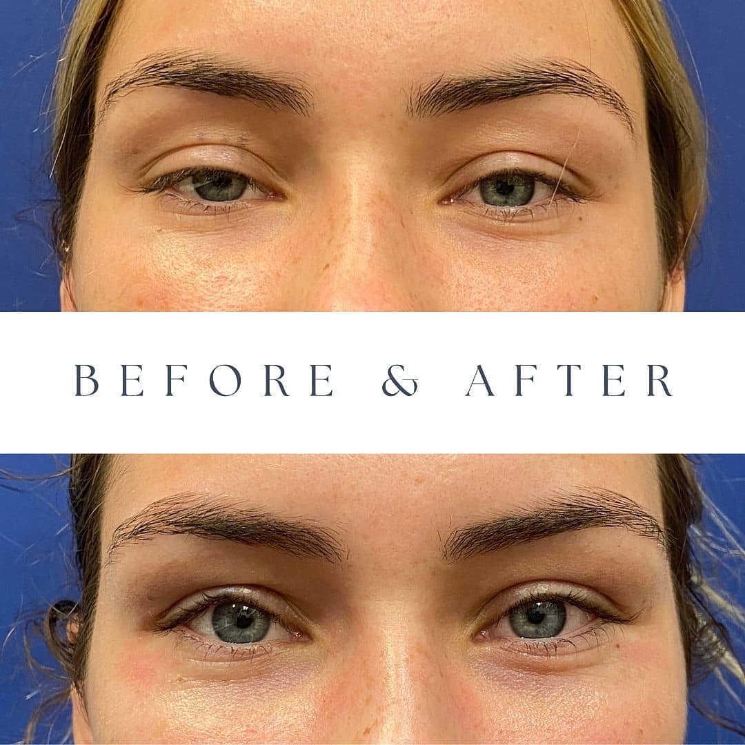 Blepharoplasty Before & After