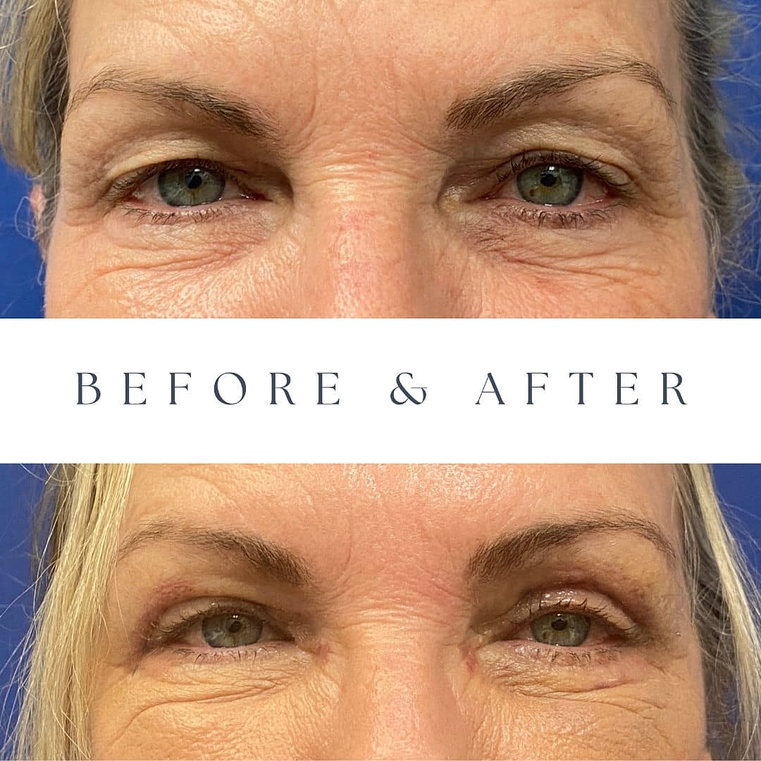 Blepharoplasty Before & After