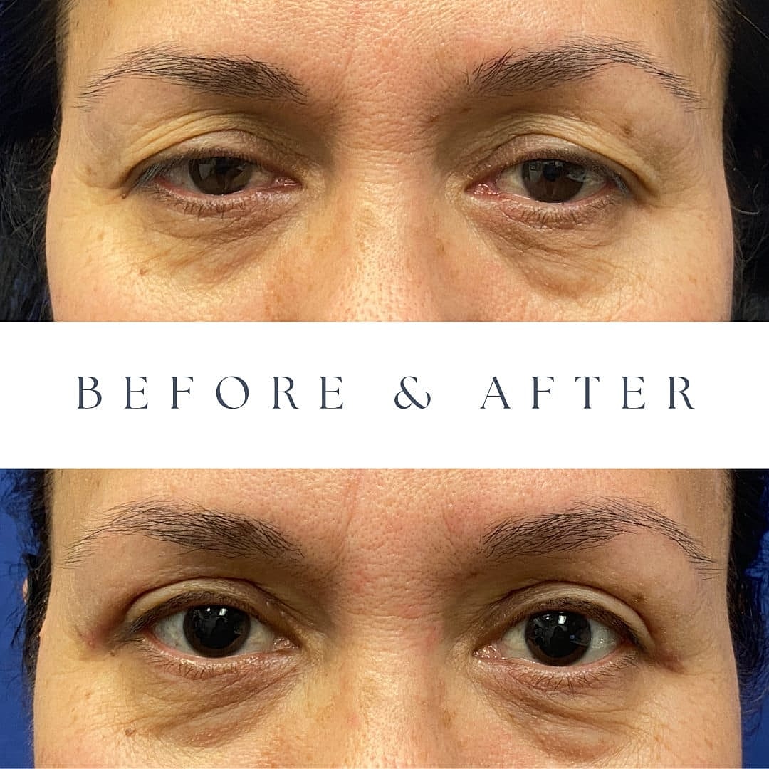 Blepharoplasty Before & After