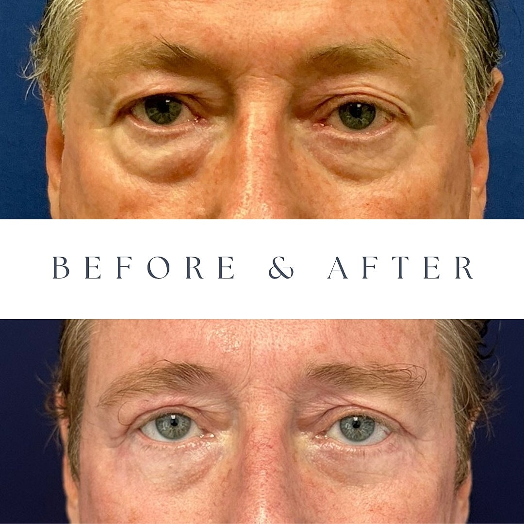 Before and after eye rejuvenation treatment photos.