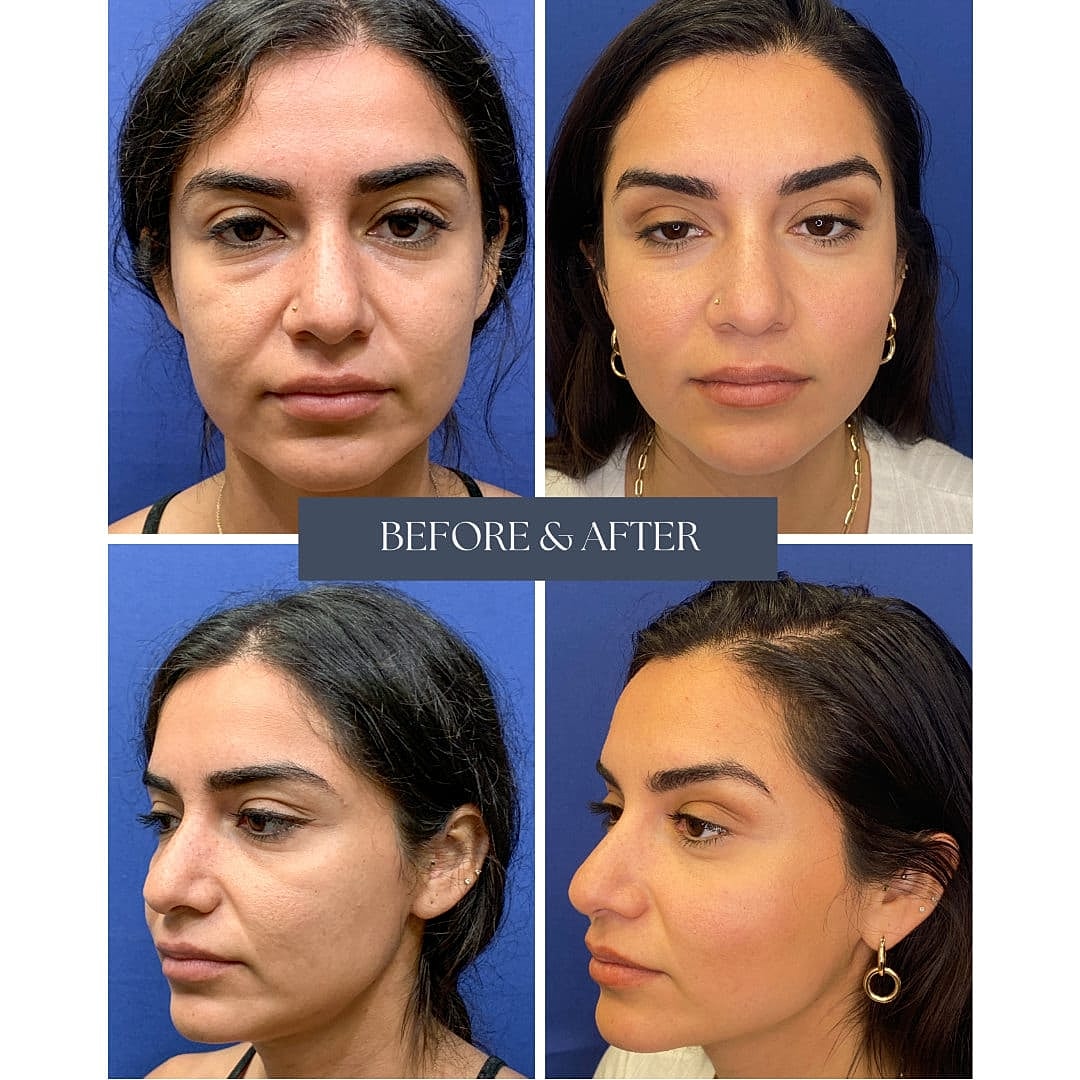 Injerto De Grasa Before & After