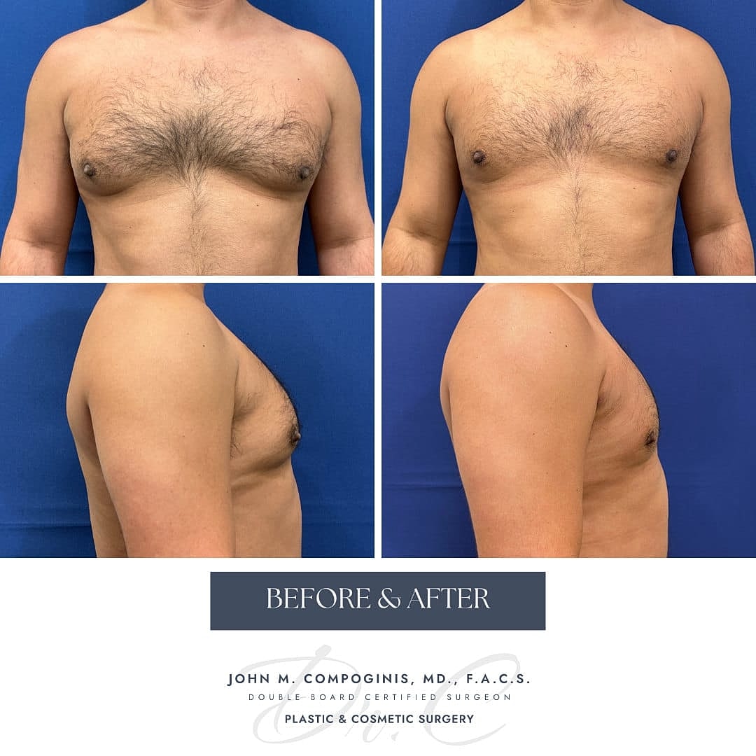 Gynecomastia Before & After
