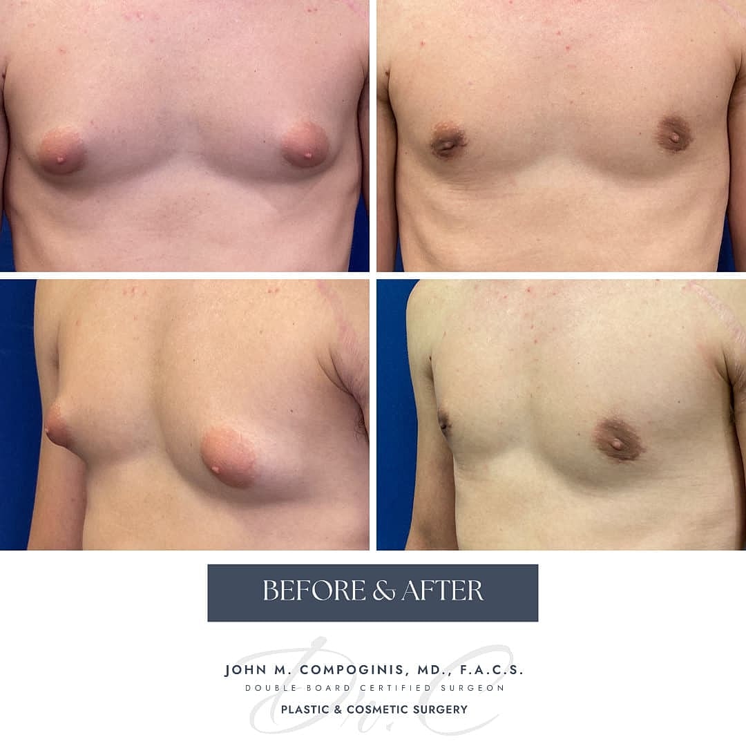 Gynecomastia Before & After