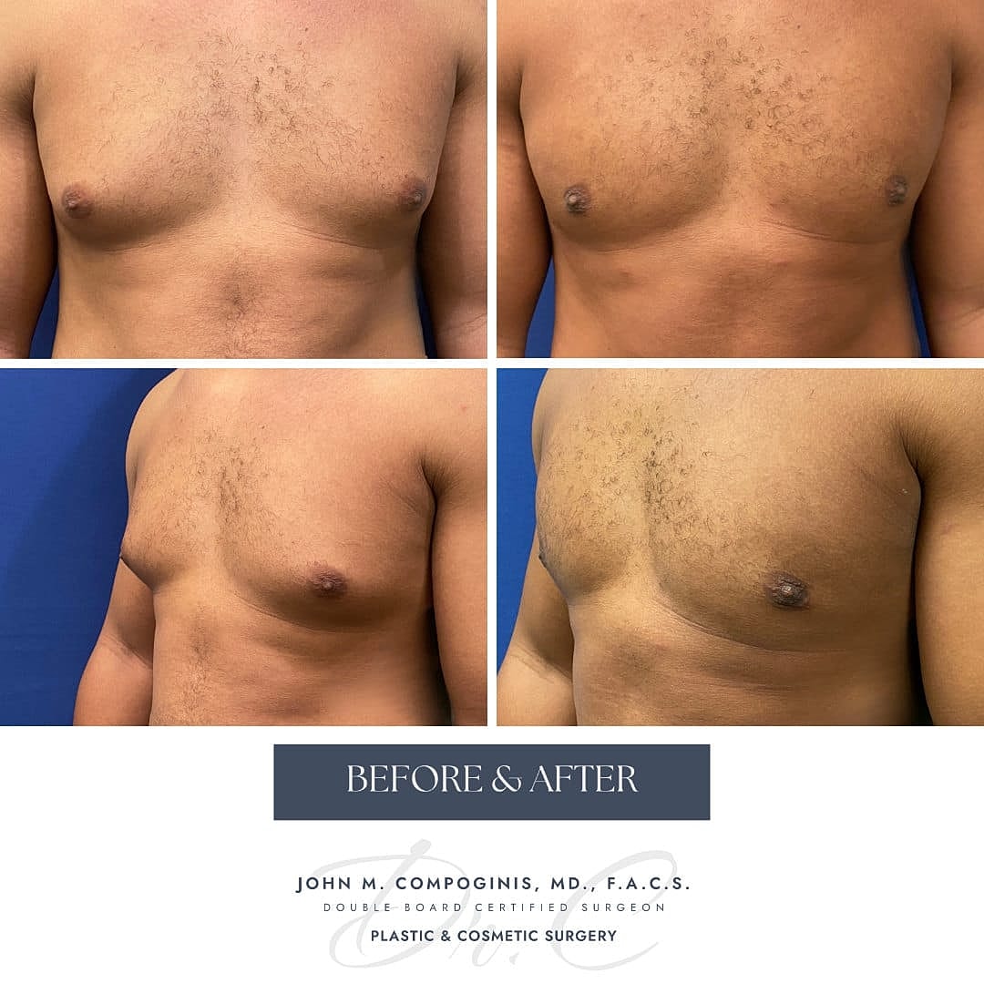 Gynecomastia Before & After