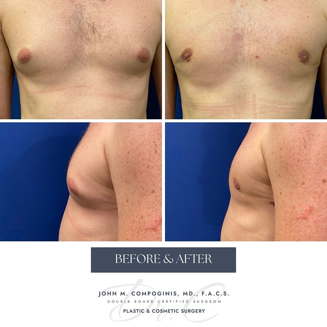 Gynecomastia Before & After