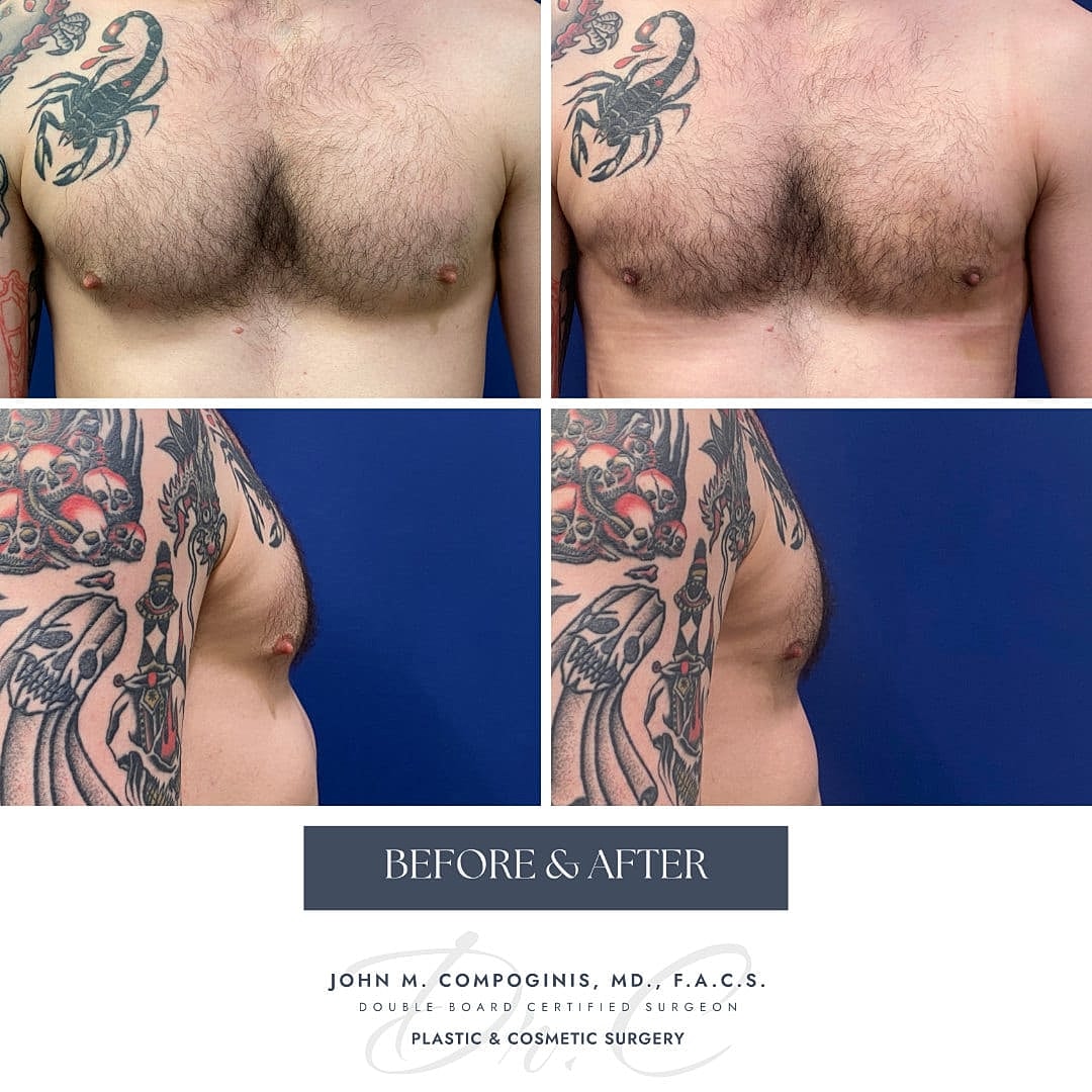 Gynecomastia Before & After
