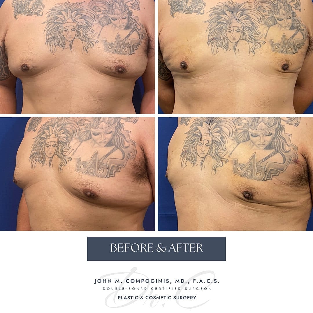Gynecomastia Before & After